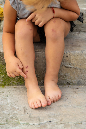 A child has a scratch on his leg. Selective focus. Kid.の写真素材