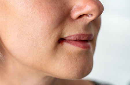 Herpes in women on the lip. Selective focus.