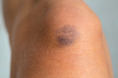 Bruise on a woman leg. Selective focus.