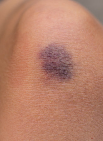 Bruise on a woman leg. Selective focus.