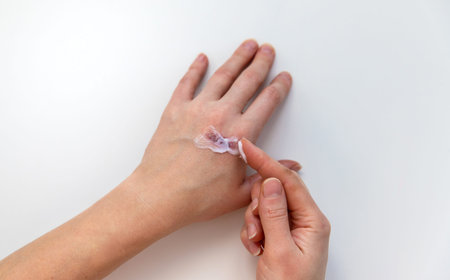 Burn on a woman hand. Selective focus.の写真素材