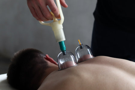 Massage vacuum cups. Close-up of man lying with banks on his back in spa salon. Vacuum jars in...