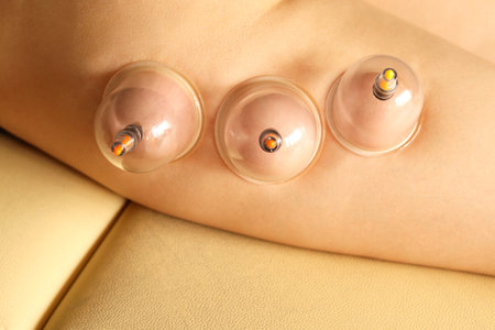 cupping therapy. Cup vacuum hip massage. Close-up of young woman's anti-cellulite procedure. The concept of beauty and a healthy body. Tools for smooth skin.の写真素材