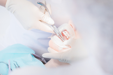 Extreme macro closeup of open female human mouth showing stainless steel braces. Inspection of the installation and removal of braces by the dentistの写真素材