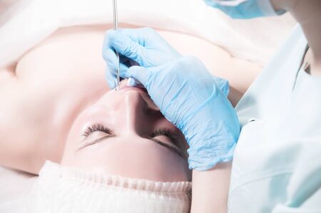 Close-up Mechanical face peel at the beautician. Beautician squeezes acne on the patient's forehead...