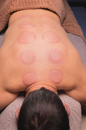 Man after cupping therapy on his back. Skin after cupping in traditional Chinese medicine. man...