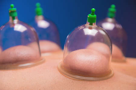 Close-up Cup massage in general. Vacuum jars for back massage for a man. Massage with vacuum cups. Cupping treatments for back pain relief. Caucasian man lies face down with mounted vacuum cupsの写真素材