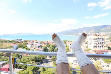Broken legs in a plaster on the balustrade balcony overlooking the seaの写真素材