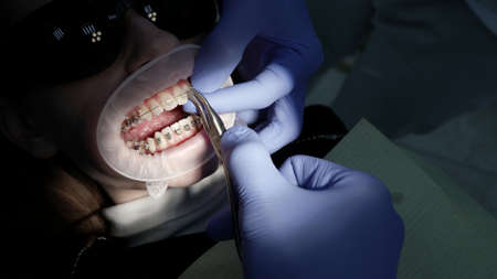 A patient with a mouth dilator in a dental chair, braces on his teeth, a doctor performs various procedures with the help of dental instruments.の写真素材