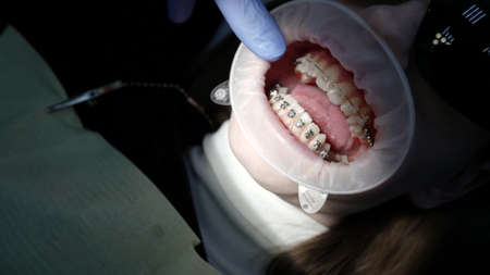 Close-up of a doctor and a patient with a mouth dilator in a dental office, braces on the teeth, various procedures are performed with the help of dental instruments.の写真素材