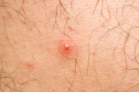 Human skin with acne. Lack of human skin