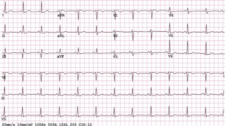 An example of a normal 12-lead sinus rhythm electrocardiogram, vector and JPEG