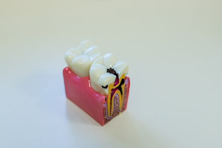 Concept of over-consumption, excessive candies, sugar consumption and dental diseases, caries, cavities. Tooth model with dental caries, abscesses surrounded by candies, sweetsの写真素材