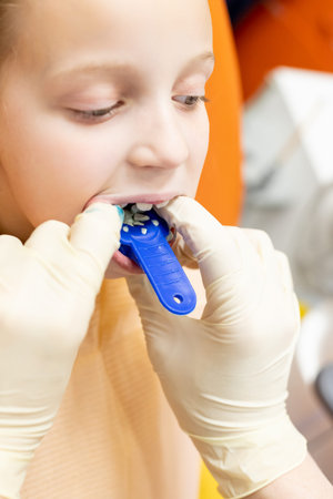 Orthodontist , tooth kids braces ,equipment teeth cast.Disorders of the teeth, upper teeth behind...