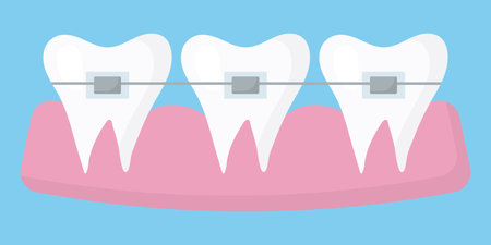Illustration of teeth with braces. Teeth alignment concept.