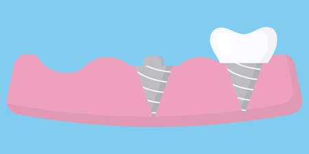 Dental prosthetics concept. Artificial tooth.のイラスト素材