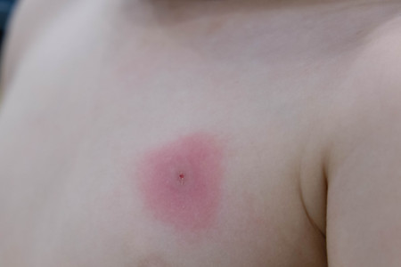 new born with multiple mosquito bites Allergy to insect bitesの写真素材