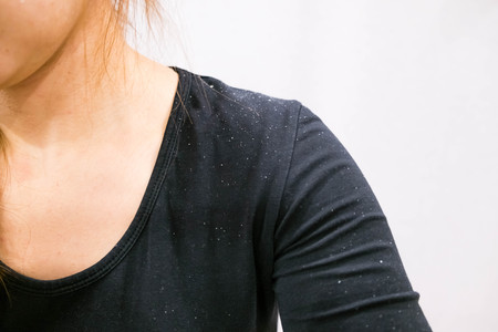 women having dandruff in the hair and shoulder. Women have itchy scalp fungus. Dander that causes itching scalpの写真素材