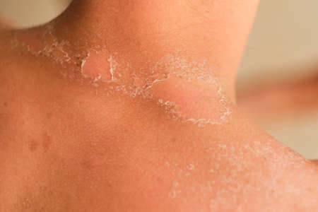 unrecognizable guy got sunburn and got tan lines on his back. The skin sloughs off it is burn skin. It looks ugly. He has a burning pain on his shoulder. He get burning pain.の写真素材