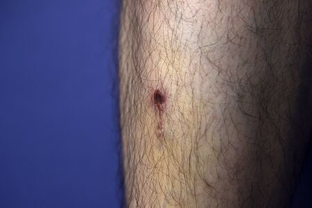 bruise and clotted blood on the leg of a young man on a blue backgroundの写真素材