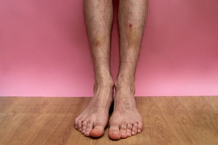 bruise and clotted blood on the leg of a young man on a pink backgroundの写真素材