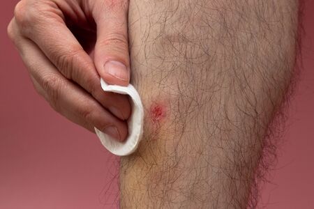 man wipes blood from his lower leg with a cotton pad with an antisepticの写真素材