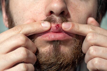 Herpes on lips of the bearded man. Shocked man showing bleeding wound with fingers.の写真素材