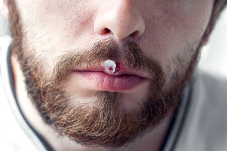 Lower part of beard man's face with herpes on his lips and hand putting cream on itの写真素材