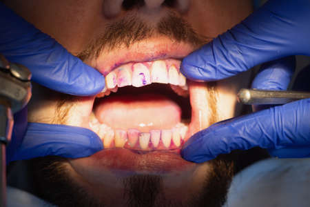 Professional oral hygiene and teeth cleaning. Applying the gel to the teeth. Prevention of caries and gum diseases.の写真素材