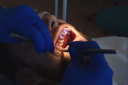Professional oral hygiene and teeth cleaning. Applying the gel to the teeth. Prevention of caries and gum diseases.の写真素材