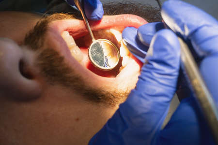 Man on examination at the dentist. Cleaning plaque and tartar in a dental clinic. Preventive Dental hygiene and check upの写真素材