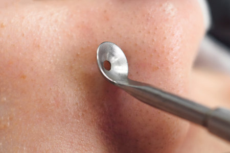 Mechanical facial cleansing with metal device at the beautician clinic. Cosmetology Professional procedure for cleansing pores and skin from defects Close-upの写真素材