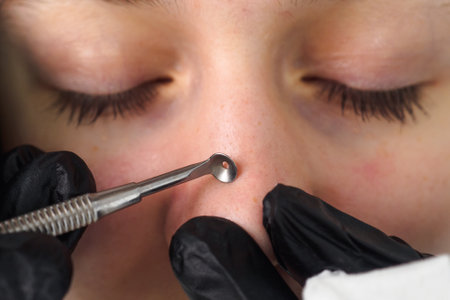 Mechanical facial cleansing with metal device at the beautician clinic. Cosmetology Professional procedure for cleansing pores and skin from defects Close-upの写真素材