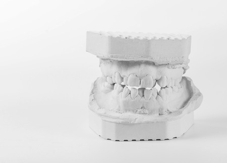 Dental casting gypsum model of human jaws. Crooked teeth and distal bite. Shots were made before treatment with braces . Technical shots on gray background.の写真素材