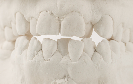 Dental casting gypsum model of human jaws. Crooked teeth and distal bite. Shots were made before treatment with braces . Technical shots on gray background.の写真素材