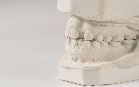 Dental casting gypsum model of human jaws. Crooked teeth and distal bite. Shots were made before treatment with braces . Technical shots on gray background.の写真素材