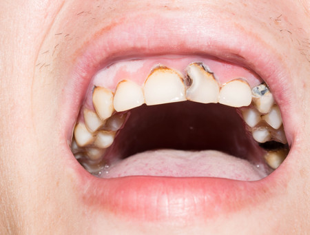 adult teeth with caries black holes spoiled for medicineの写真素材