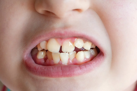 Close-up of a child's teeth with an open mouth.