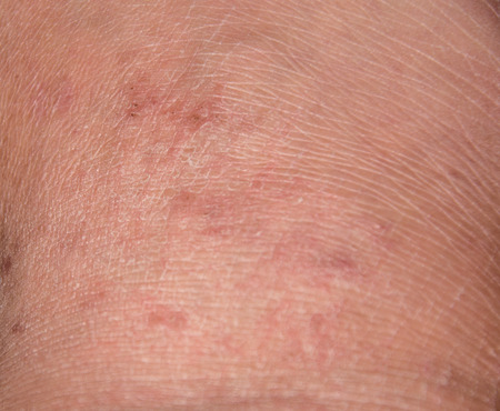 Dry cracking skin in the winter