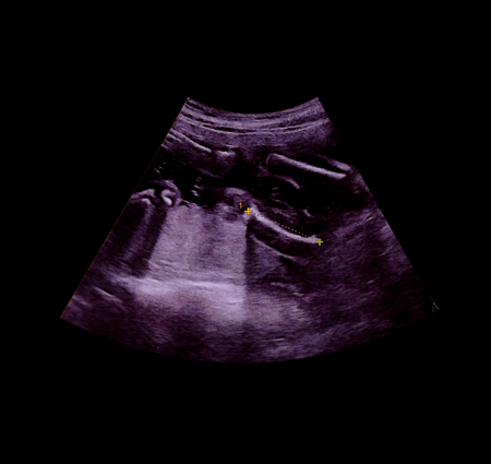 Ultrasound image boy baby on black backgroundの写真素材