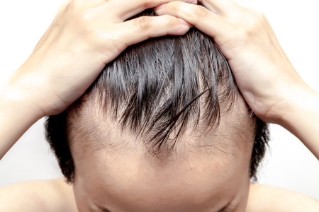Bald man or woman worry about his or her less hairline on white background isolatedの写真素材