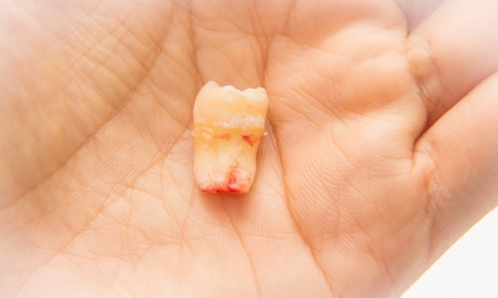  wisdom tooth, in humans, is any of the usual four third molars の写真素材
