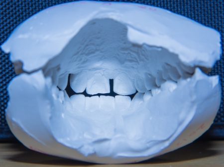 dental cast--important to orthodonticsの写真素材