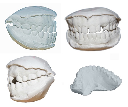 dental cast--important to orthodontics