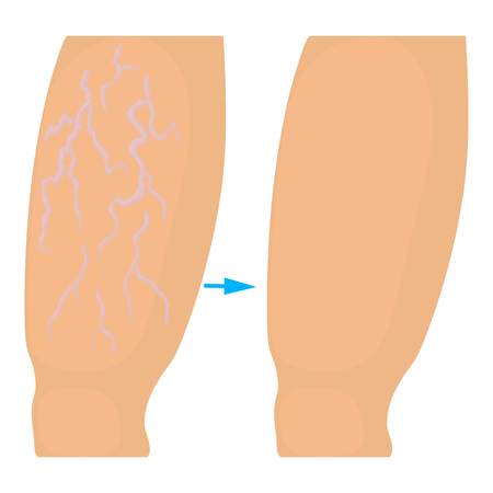 Varicose veins operation icon. Cartoon illustration of varicose veins operation vector icon for webのイラスト素材