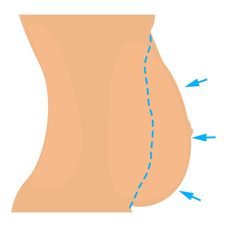 Belly plastic correction icon. Cartoon illustration of belly plastic correction vector icon for webのイラスト素材