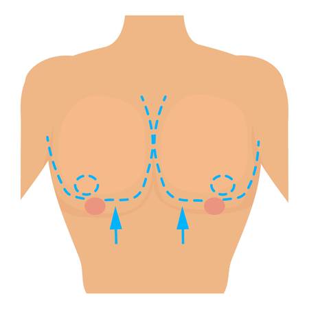 Woman breast marked out for cosmetic surgery icon. Cartoon illustration of woman breast marked out for cosmetic surgery vector icon for webのイラスト素材