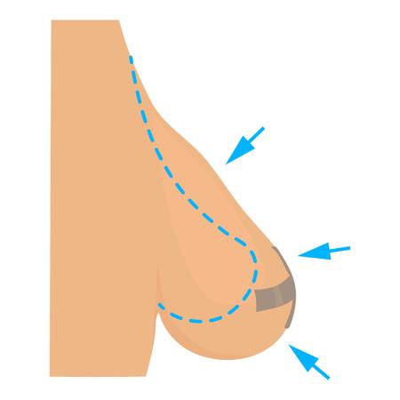 Breast reduction plastic correction icon. Cartoon illustration of breast reduction plastic correction vector icon for webのイラスト素材