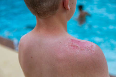 Close up of the sun burnt skin on a Young boy's shoulder. Selective focus on the dead peeling skin after a severe sunburnの写真素材