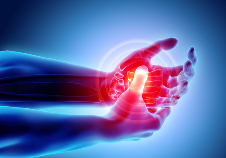 3D illustration of Palm painful - skeleton x-ray, medical concept.の写真素材